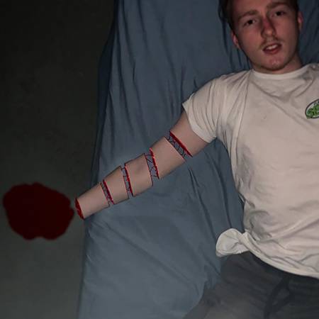 Saxo_Broko laying on bed with chopped up arm and no hand.